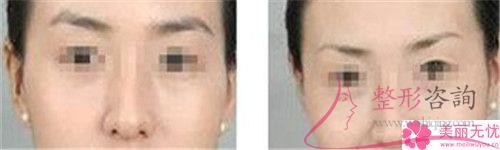 <a href=http://www.sbs17.com/listinfo-658-0.html target=_blank class=infotextkey>洗眉</a>毛用激光能清潔凈嗎？費(fèi)用是呢