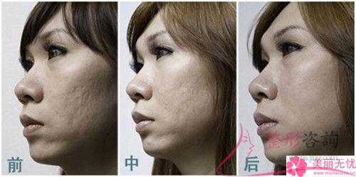 美萊激光祛痘該怎樣打理？結(jié)果如何？