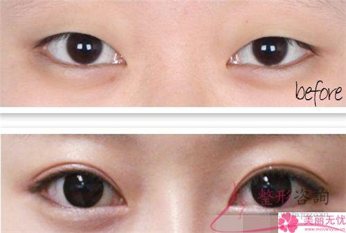 韓式<a href=http://www.sbs17.com/listinfo-724-0.html target=_blank class=infotextkey>雙眼皮</a>法是埋線<a href=http://www.sbs17.com/listinfo-724-0.html target=_blank class=infotextkey>雙眼皮</a>法嗎？是可以保持多長(zhǎng)時(shí)間