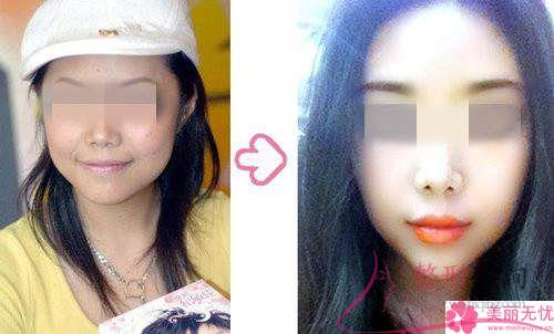 下<a href=http://www.sbs17.com/listinfo-644-0.html target=_blank class=infotextkey>頜骨整形</a>術(shù)能不能讓我成為瓜子臉