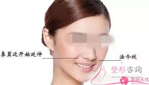 四個高頻出現(xiàn)的除掉法令紋的不良癥狀