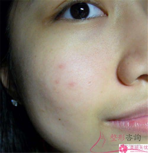 外眼角切開術(shù)的含義？有留疤痕的危害嗎？