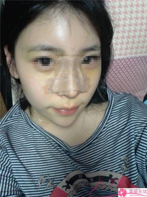 打微晶瓷<a href=http://www.sbs17.com/listinfo-737-0.html target=_blank class=infotextkey>隆鼻</a>的注意事項有哪些