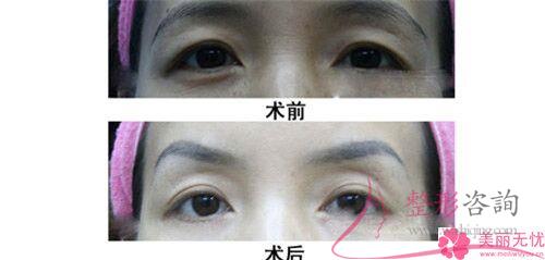 激光<a href=http://www.sbs17.com/listinfo-658-0.html target=_blank class=infotextkey>洗眉</a>毛改善效果與費用各自是什么