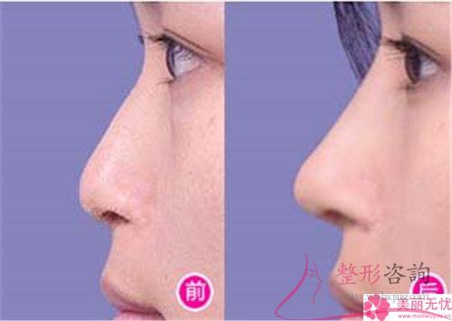 <a href=http://www.sbs17.com/listinfo-755-0.html target=_blank class=infotextkey>鼻小柱延長</a>適用于哪些人進行
