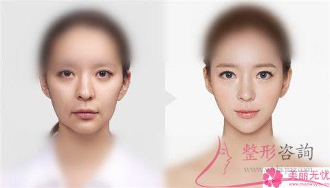 做縮小<a href=http://www.sbs17.com/listinfo-754-0.html target=_blank class=infotextkey>鼻翼</a>術是什么價格