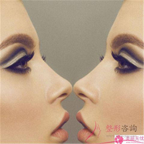 做縮小<a href=http://www.sbs17.com/listinfo-754-0.html target=_blank class=infotextkey>鼻翼</a>的價格如何收費