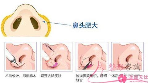 做<a href=http://www.sbs17.com/listinfo-754-0.html target=_blank class=infotextkey>鼻翼</a>整形術價格介紹