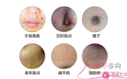 醫(yī)美<a href=http://www.sbs17.com/listinfo-795-0.html target=_blank class=infotextkey>祛斑</a>期間如果臉上特別紅正常嗎