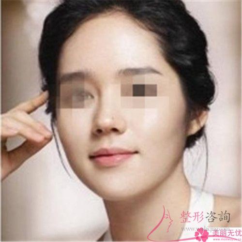 <a href=http://www.sbs17.com/listinfo-737-0.html target=_blank class=infotextkey>隆鼻</a>手術(shù)失敗具體是由于什么原因造成