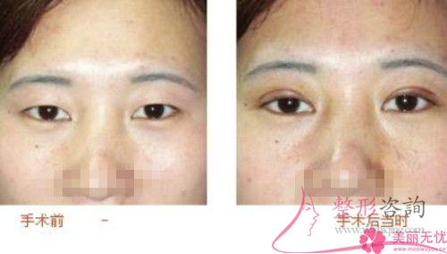 上瞼提肌縮短術(shù)的手術(shù)費(fèi)用一般是8237元嗎