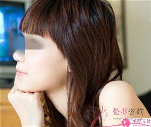 溫州<a href=http://www.sbs17.com/listinfo-731-0.html target=_blank class=infotextkey>玻尿酸</a>面部填充<a href=http://www.sbs17.com/listinfo-614-0.html target=_blank class=infotextkey>除皺</a>術手術費用貴嗎