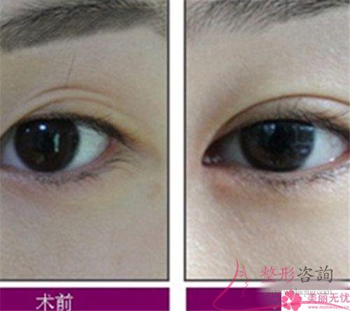 割<a href=http://www.sbs17.com/listinfo-724-0.html target=_blank class=infotextkey>雙眼皮</a>手術(shù)不理想情況有些什么