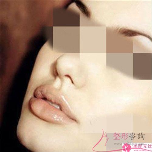 實(shí)施重唇修復(fù)手術(shù)有何手術(shù)風(fēng)險(xiǎn)嗎