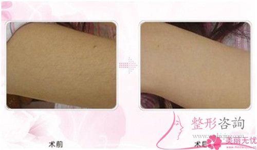 彩光<a href=http://www.sbs17.com/listinfo-670-0.html target=_blank class=infotextkey>脫毛</a>不成功到底怎么樣正確處理