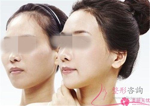 手術(shù)方法進行面部提拉對皮膚損害嚴不嚴重