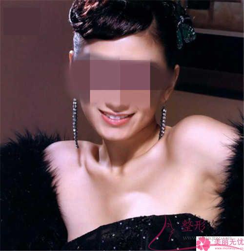 手術(shù)方法進行面部提拉對皮膚損害嚴不嚴重