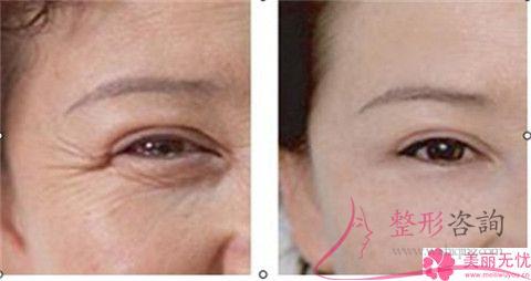 毛孔粗能實行彩光<a href=http://www.sbs17.com/listinfo-770-0.html target=_blank class=infotextkey>嫩膚</a>嗎