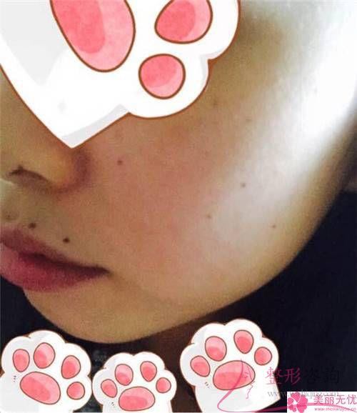 激光去咖啡斑手術(shù)只滿足身體健康便能嗎？