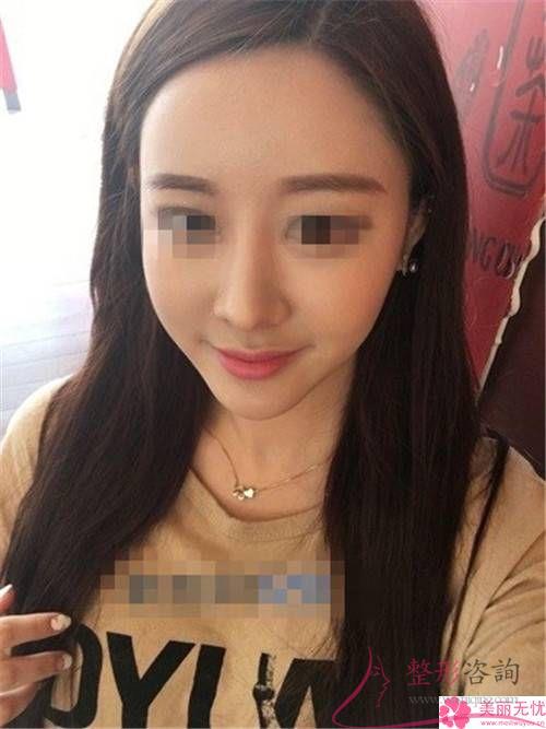空鼻手術(shù)治療效果怎么