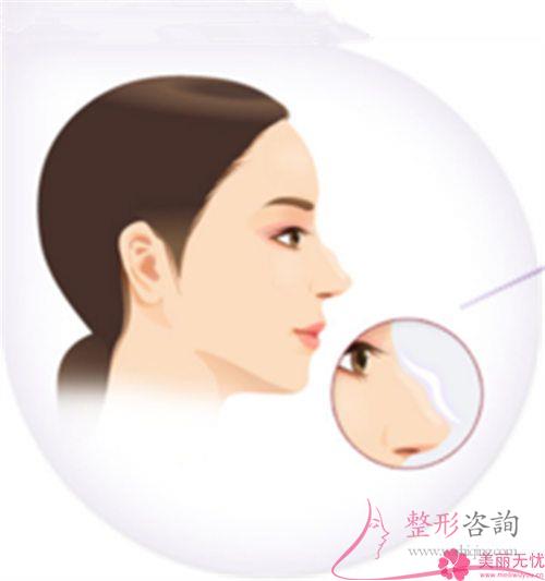 膨體聚四氟乙烯<a href=http://www.sbs17.com/listinfo-737-0.html target=_blank class=infotextkey>隆鼻</a>術靠譜嗎？是否有造成感染？
