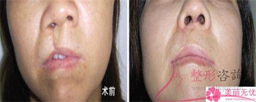 蒜頭鼻醫(yī)療整形可以變更我們的鼻子什么后遺癥