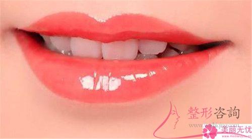 重唇矯治術(shù)可以改變哪些問題
