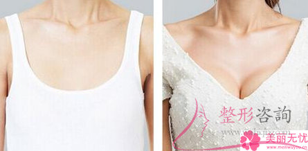 雪藍(lán)貝假體<a href=http://www.sbs17.com/listinfo-618-0.html target=_blank class=infotextkey>隆胸</a>需要好多錢(qián)？效果到底好不好？