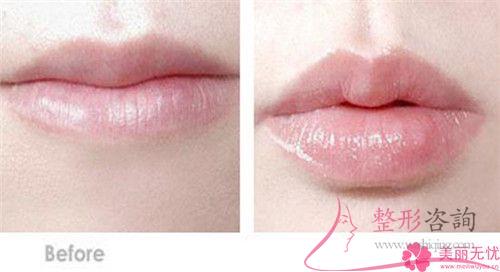 做唇珠成形手術(shù)一般使用次數(shù)最多的是哪種材料