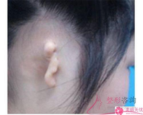 <a href=http://www.sbs17.com/listinfo-698-0.html target=_blank class=infotextkey>招風(fēng)耳矯正</a>手術(shù)可以使用免拆除的縫線嗎