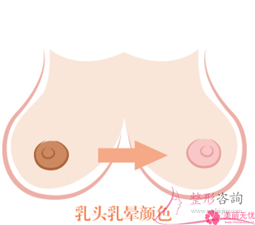 進(jìn)行<a href=http://www.sbs17.com/listinfo-625-0.html target=_blank class=infotextkey>乳暈縮小</a>術(shù)之前需要避免服用什么藥物