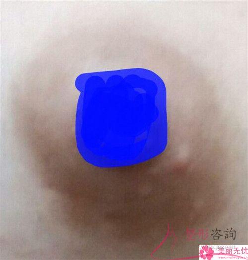 女性在做乳暈激光漂紅可能會遇到的風(fēng)險(xiǎn)多嗎
