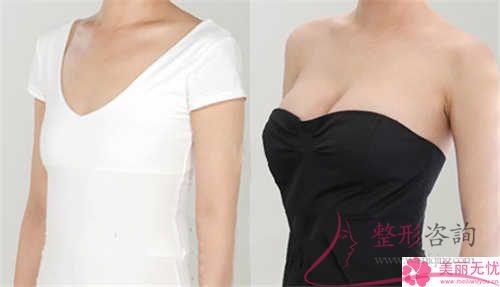 假體<a href=http://www.sbs17.com/listinfo-618-0.html target=_blank class=infotextkey>隆胸</a>費用大致是多少？