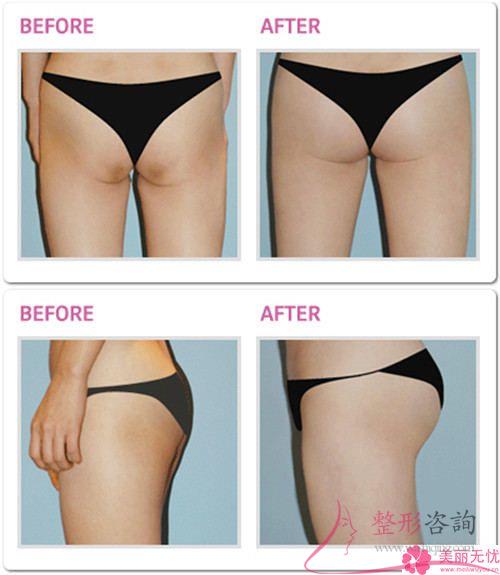 哪些女人可以做自體組織<a href=http://www.sbs17.com/listinfo-677-0.html target=_blank class=infotextkey>豐臀</a>術(shù)