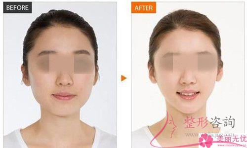 改臉型手術(shù)都有哪些方法