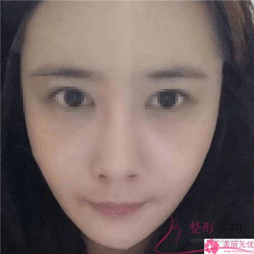 臉上脂肪細(xì)胞多注入<a href=http://www.sbs17.com/listinfo-682-0.html target=_blank class=infotextkey>溶脂</a>整形術(shù)還是botox
