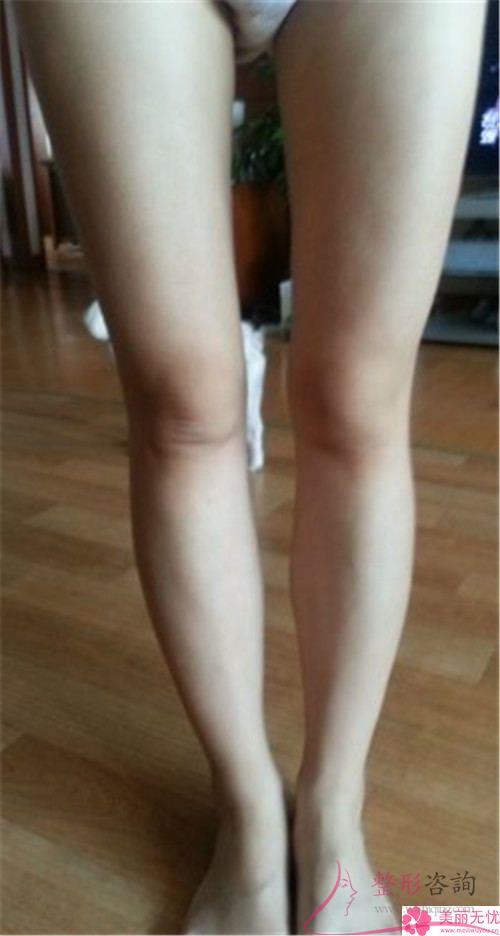 自體脂肪<a href=http://www.sbs17.com/listinfo-677-0.html target=_blank class=infotextkey>豐臀</a>術的4個好處