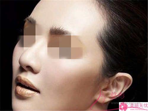 鼻中隔軟骨<a href=http://www.sbs17.com/listinfo-737-0.html target=_blank class=infotextkey>隆鼻</a>的費用大概得花多少錢