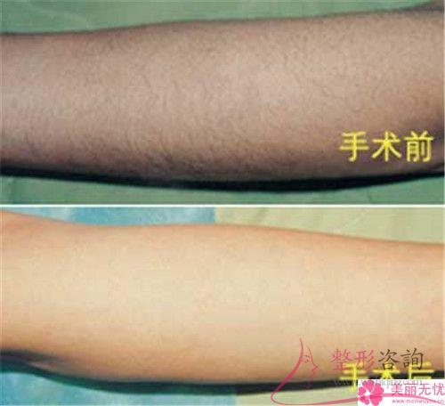 女生小胡子<a href=http://www.sbs17.com/listinfo-670-0.html target=_blank class=infotextkey>脫毛</a>選冰點(diǎn)有哪些優(yōu)點(diǎn)