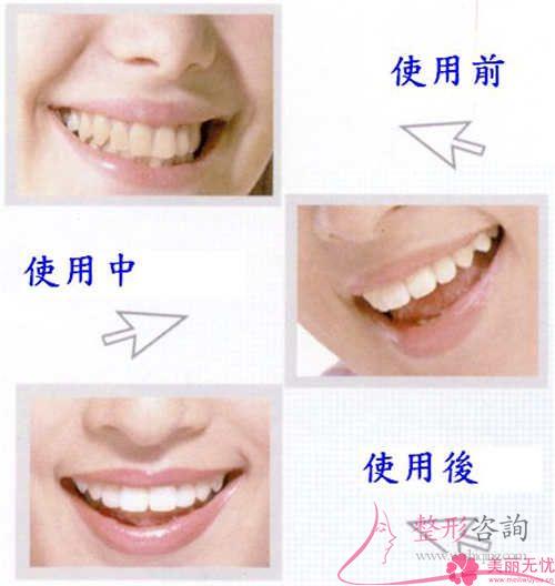 牙齒修復(fù)顆牙齒要準(zhǔn)備多少？