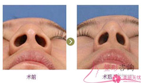 縮小<a href=http://www.sbs17.com/listinfo-754-0.html target=_blank class=infotextkey>鼻翼</a>怎么避免瘢痕增生