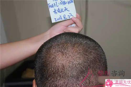 長久性局部脫發(fā)的美麗女性可不可以頭發(fā)植