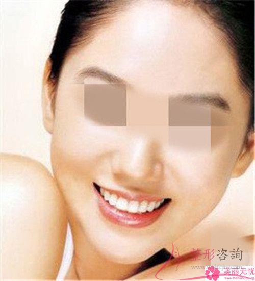 面頰的干紋是否能采取POP蛋白鋸齒線埋線<a href=http://www.sbs17.com/listinfo-614-0.html target=_blank class=infotextkey>除皺</a>術(shù)祛除