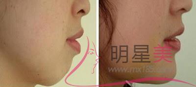 <a href=http://www.sbs17.com/listinfo-635-0.html target=_blank class=infotextkey>去頰脂墊</a>術(shù)后護理