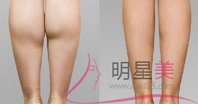 腿上肌肉多鼓了一塊