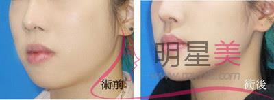 <a href=http://www.sbs17.com/listinfo-635-0.html target=_blank class=infotextkey>去頰脂墊</a>術(shù)后注意事項