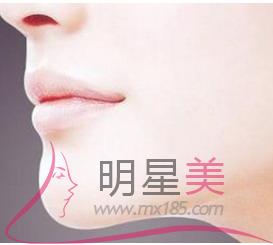 什么是假體豐下巴恢復(fù)？