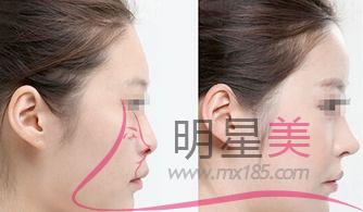 打<a href=http://www.sbs17.com/listinfo-731-0.html target=_blank class=infotextkey>玻尿酸</a>什么用