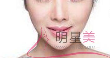 自體脂肪<a href=http://www.sbs17.com/listinfo-643-0.html target=_blank class=infotextkey>豐額頭</a>恢復期多久