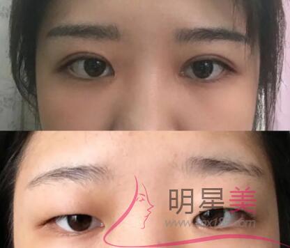 假體豐下巴風(fēng)險大不大
